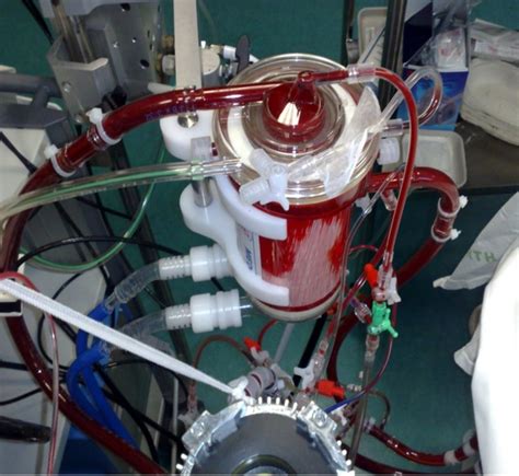 ecmo pump centrifugal|ecmo indication.